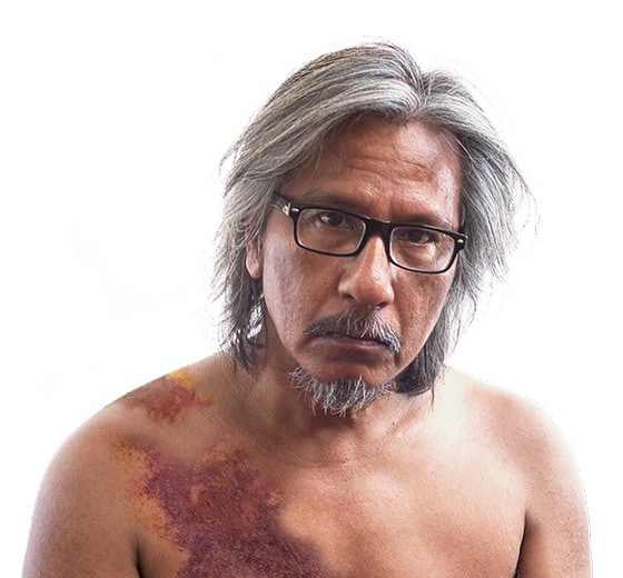 Image of man with bruising on his torso