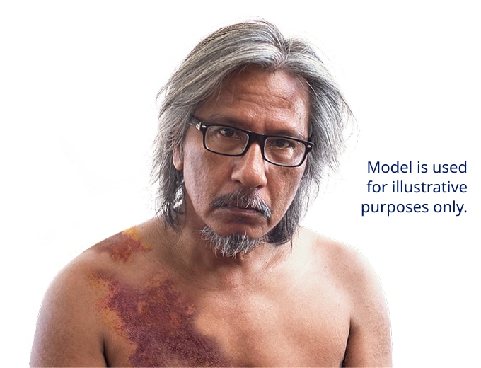 Image of man with bruising on his torso